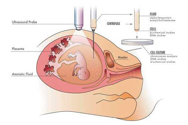 香港验血7周费用,宫腔积液如何影响辅助生殖技术中助孕过程？